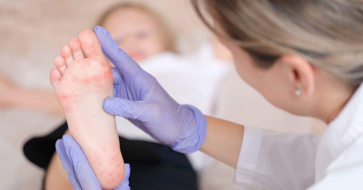 What Parents Need to Know About Hand Foot and Mouth Disease During Outbreak Season